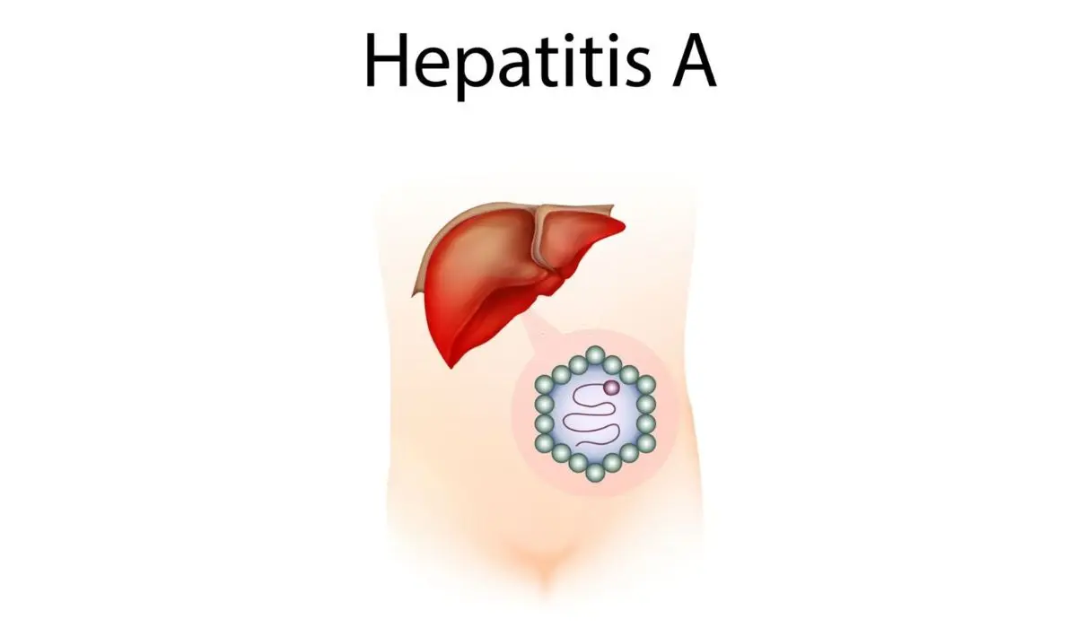 Overview Of Hepatitis A