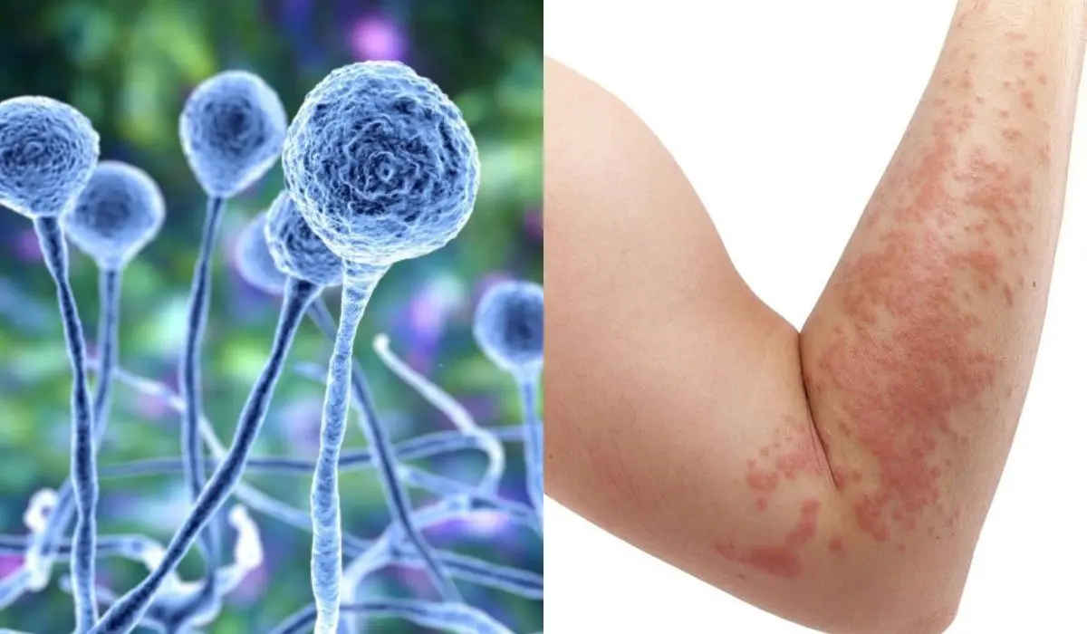 Fungal Skin Infection vs. Eczema